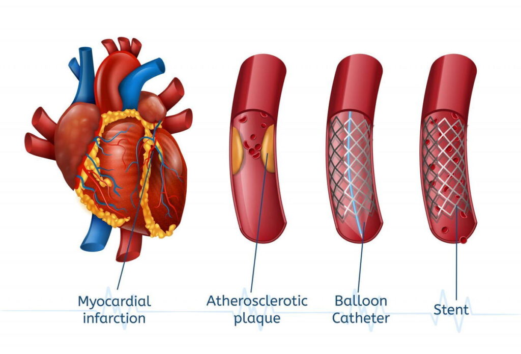 Angioplasty and Stenting in Gachibowli, Hyderabad