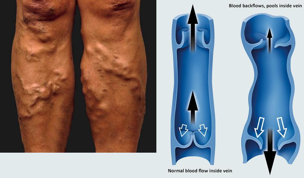 Spider Veins and Cosmetic Vein Treatment in Gachibowli, Hyderabad