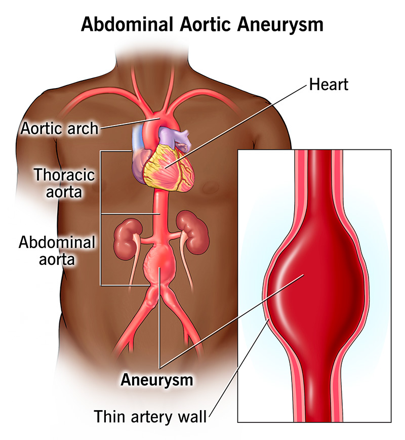 Aortic Aneurysm Treatment in Gachibowli, Hyderabad