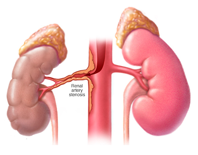 Renal Artery Stenosis Treatment in Gachibowli, Hyderabad