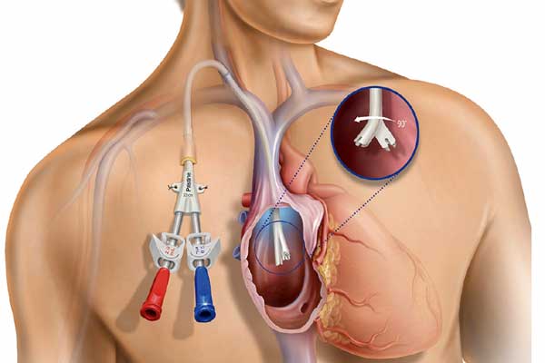 Catheter Placement in Gachibowli, Hyderabad