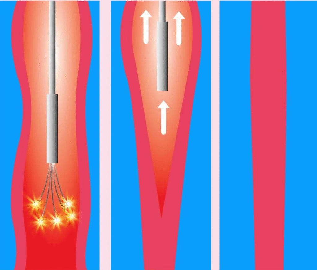 Radiofrequency Ablation (RFA) in Gachibowli, Hyderabad