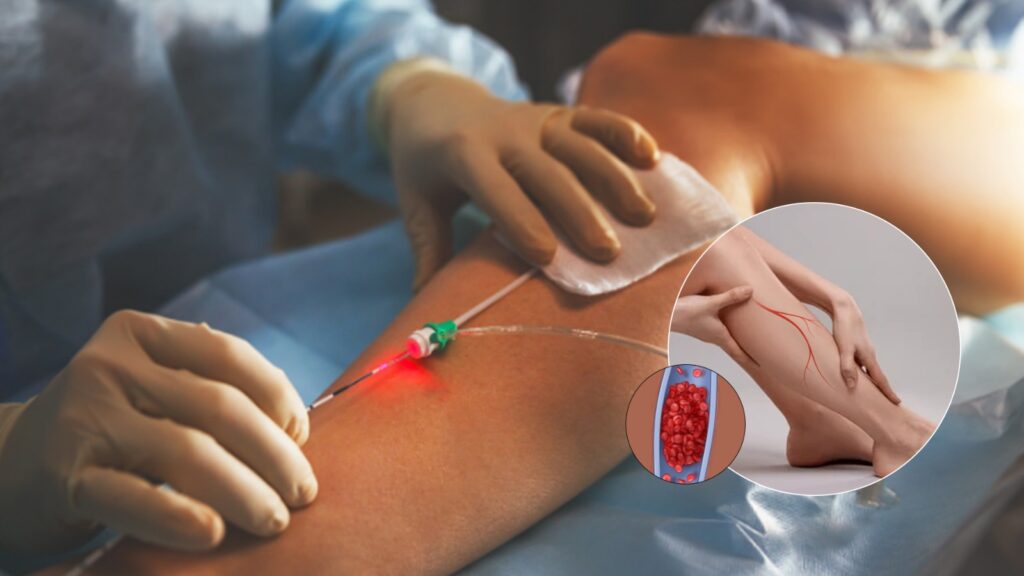 Laser Treatment for Varicose Veins (EVLT) in Gachibowli, Hyderabad