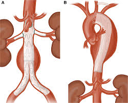 Aneurysm Repair Surgery in Gachibowli, Hyderabad