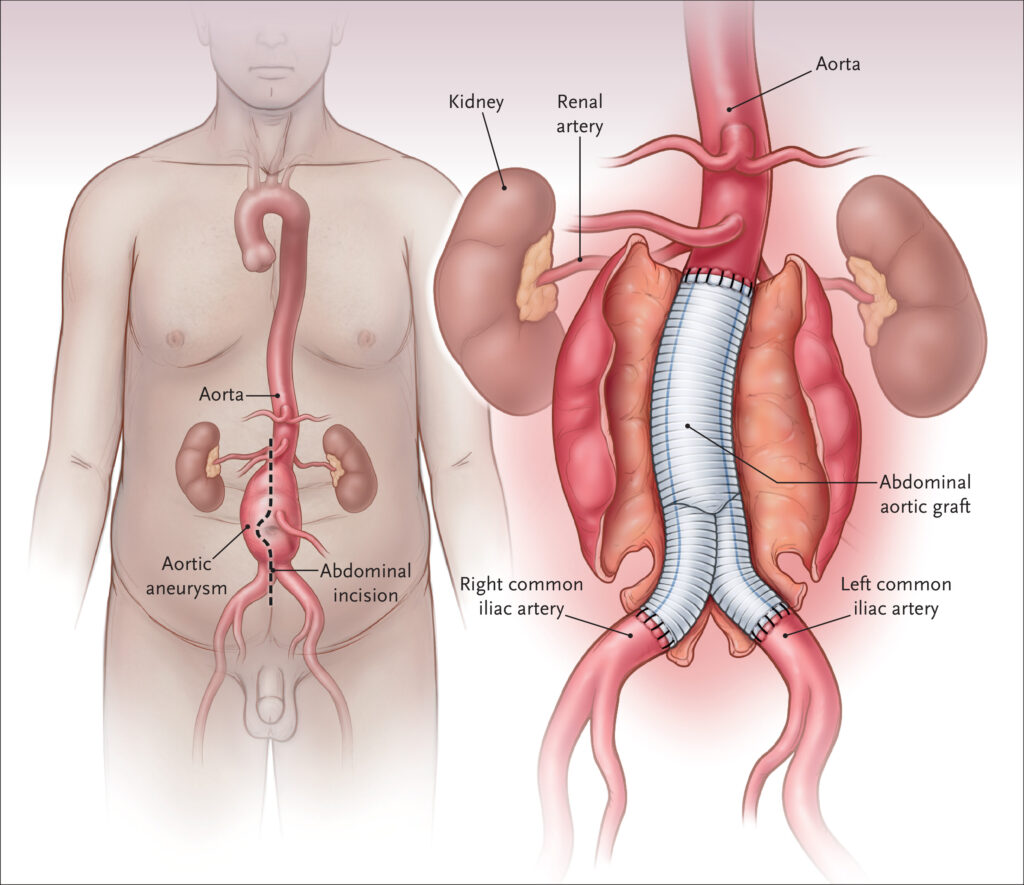 Endovascular Aneurysm Repair (EVAR) in Gachibowli, Hyderabad