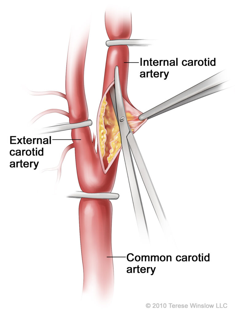 Carotid Endarterectomy in Gachibowli, Hyderabad