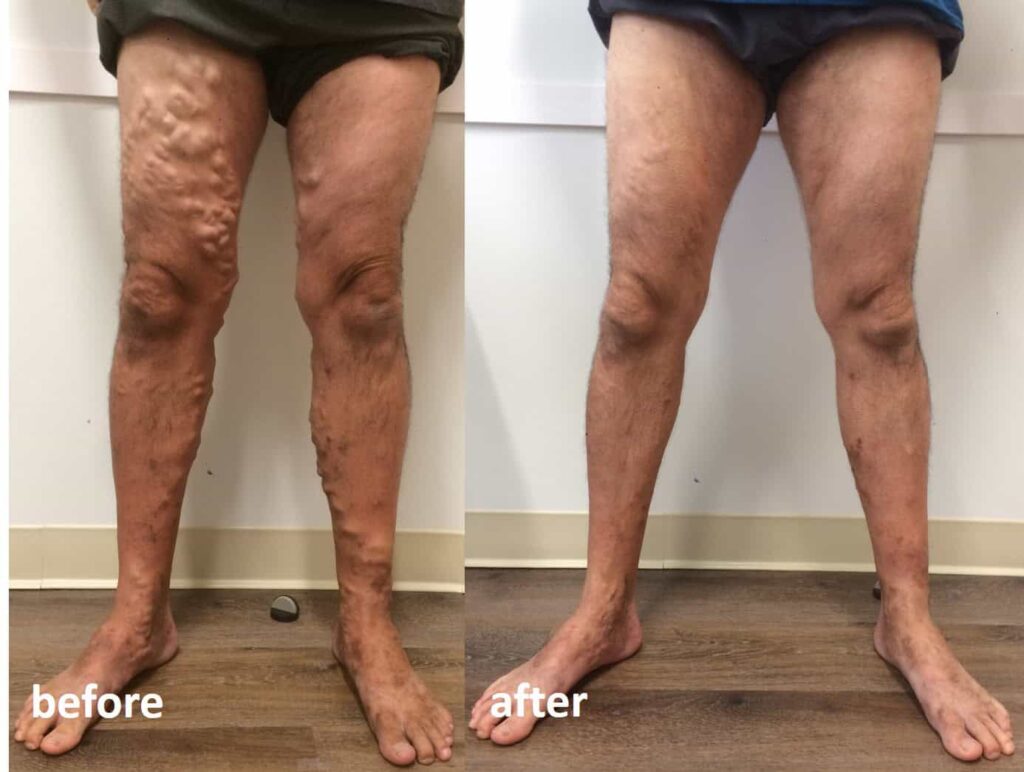 Varicose Veins Treatment In Gachibowli, Hyderabad