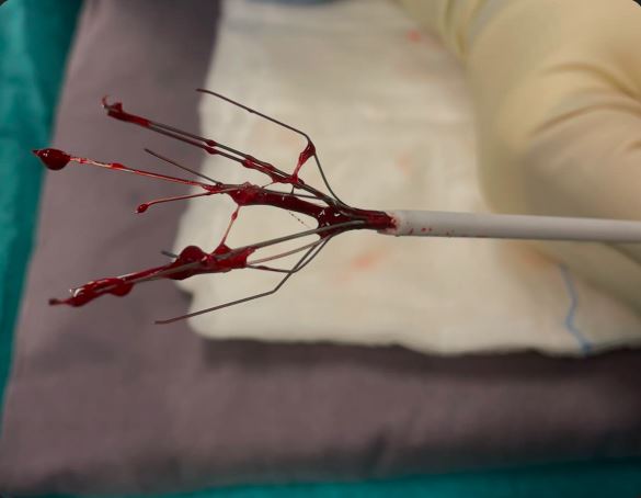 IVC Filter Insertion