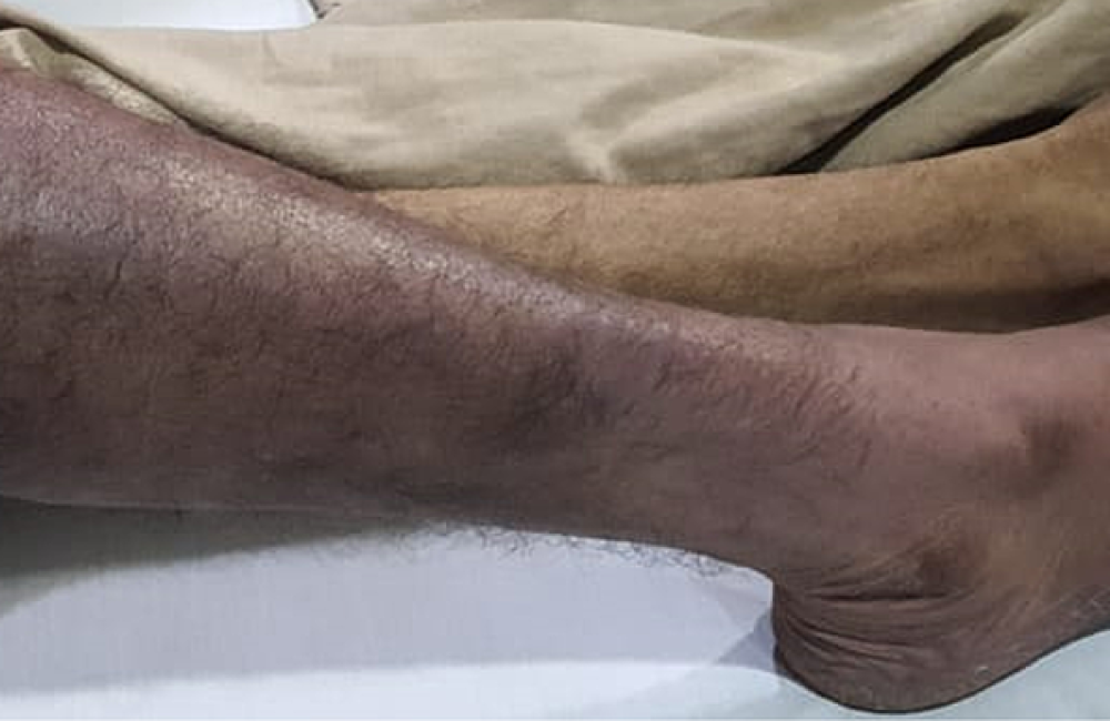 Acute Limb Ischemia