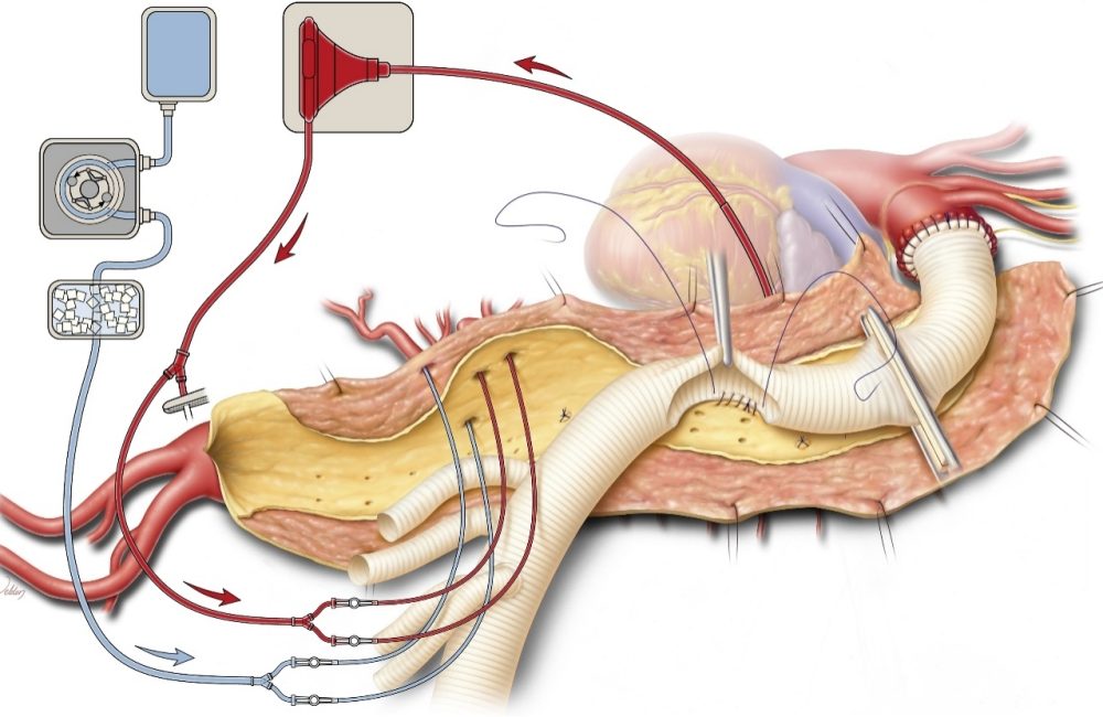 Arterial Aneurysm Repair