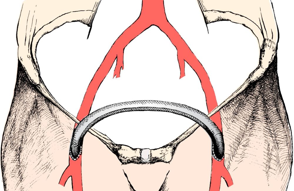 Axillo-Bifemoral Bypass