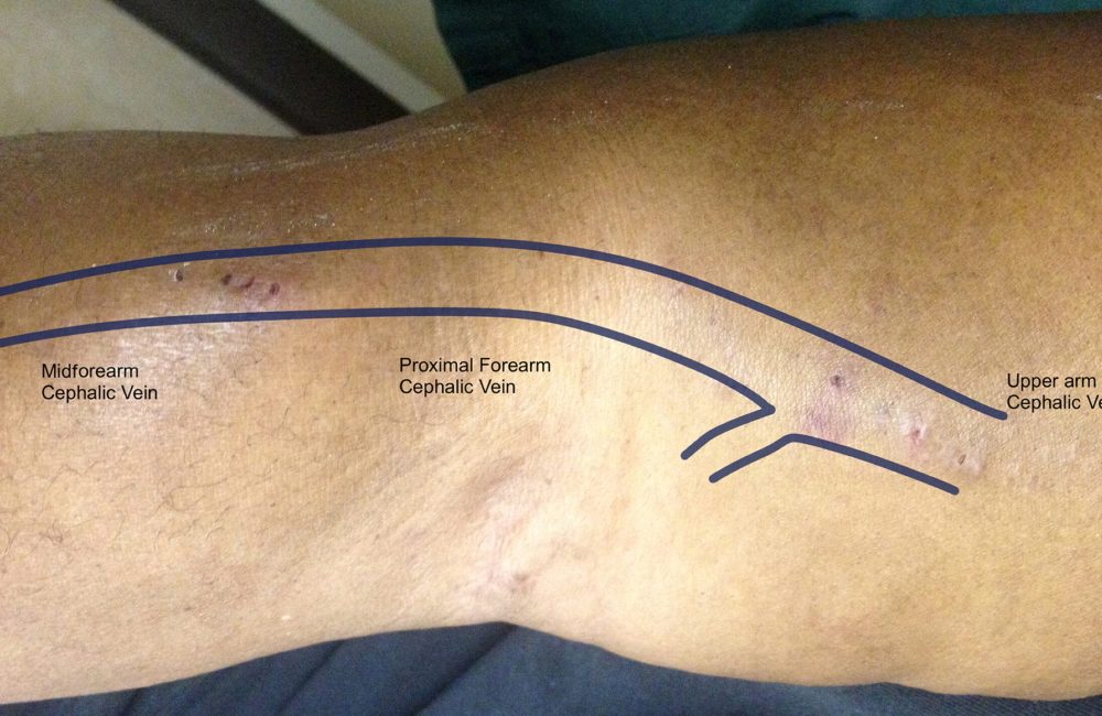 Basilic Vein Transposition