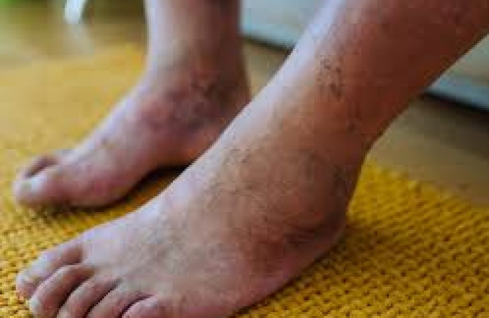 Chronic Limb Ischemia