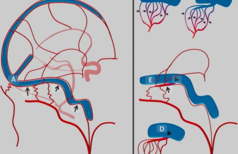 Fistula Embolectomy