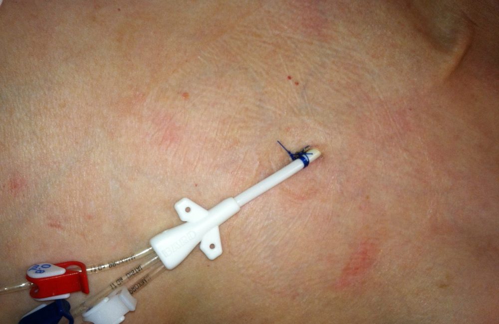 Hickman Line