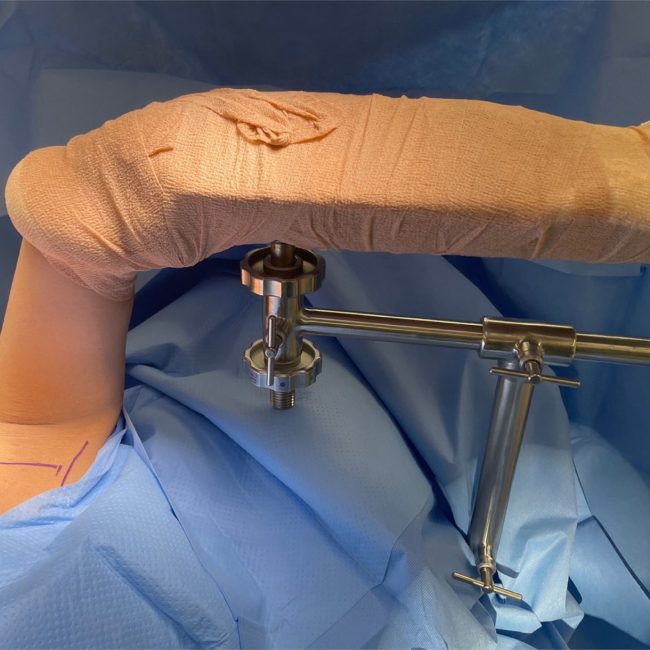 Thoracic Outlet Syndrome - Cervical Rib Excision