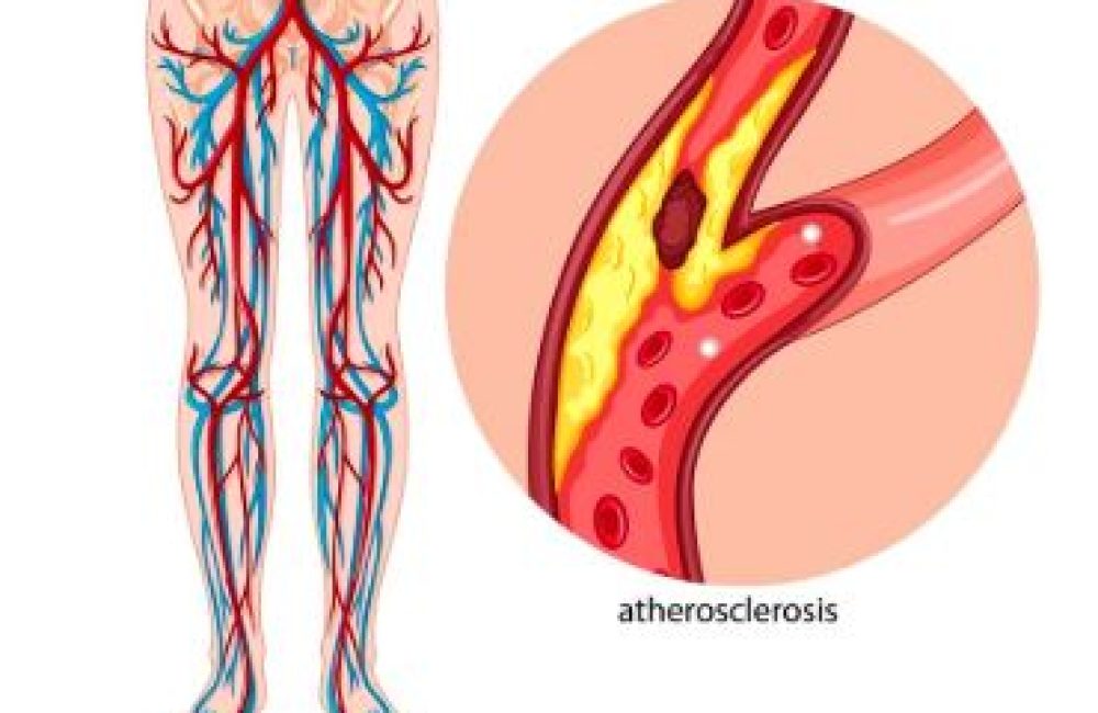 Arterial Bypass for Vascular Trauma