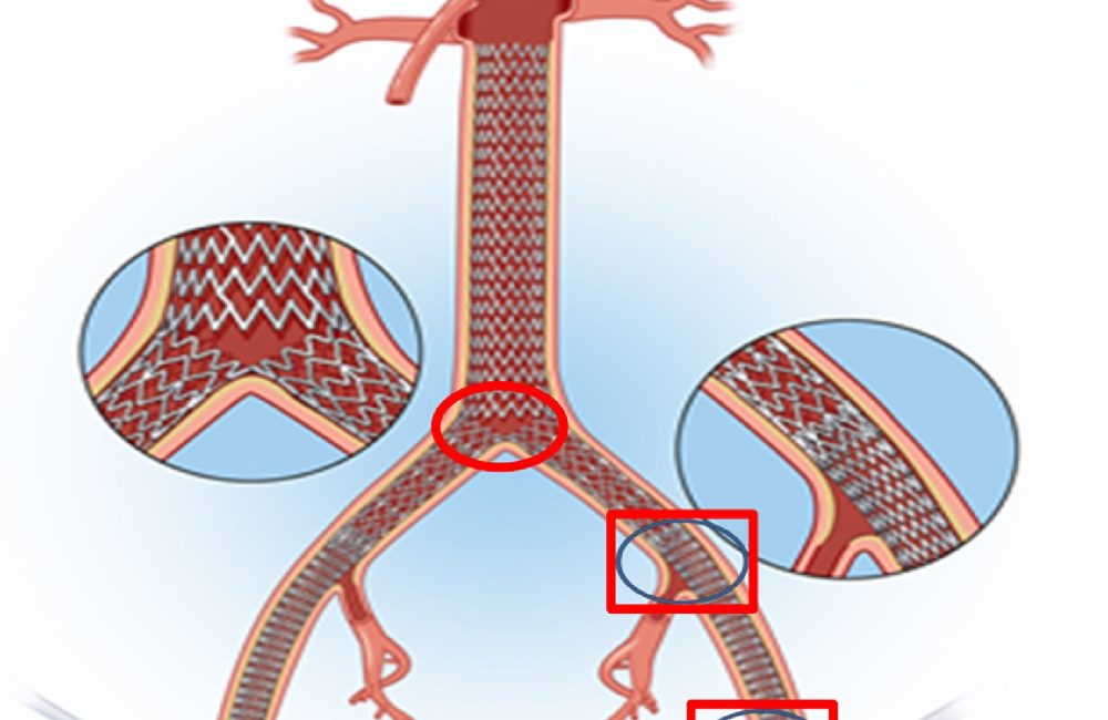 Aorto-Bifemoral Bypass