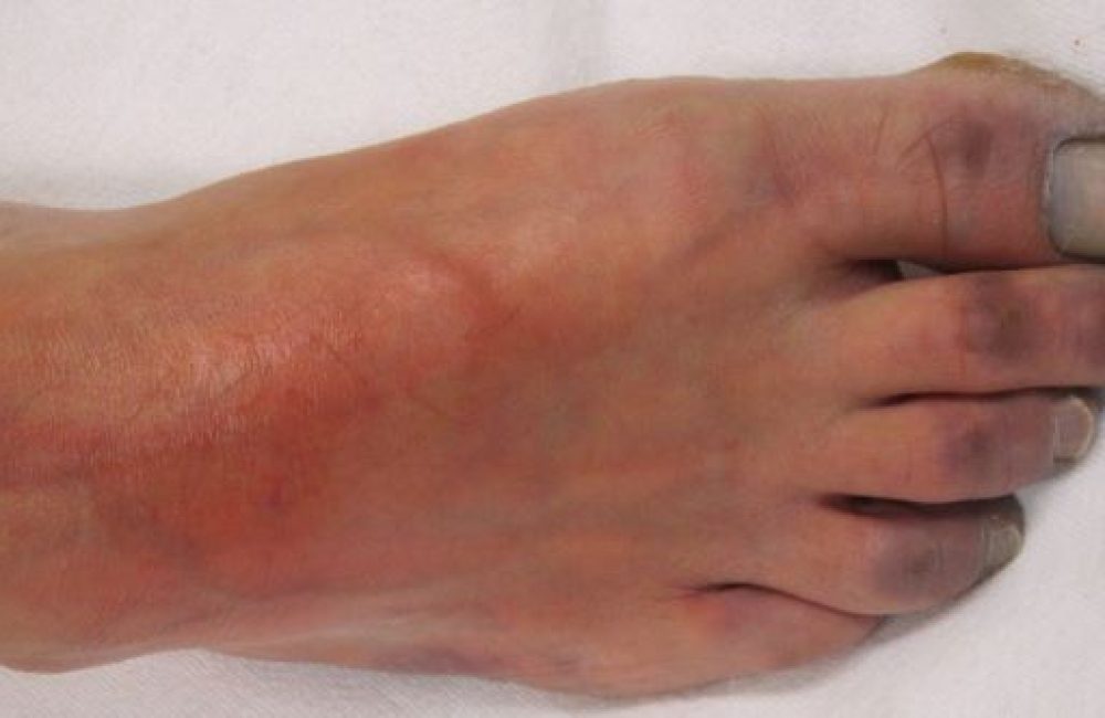 Acute Limb Ischemia