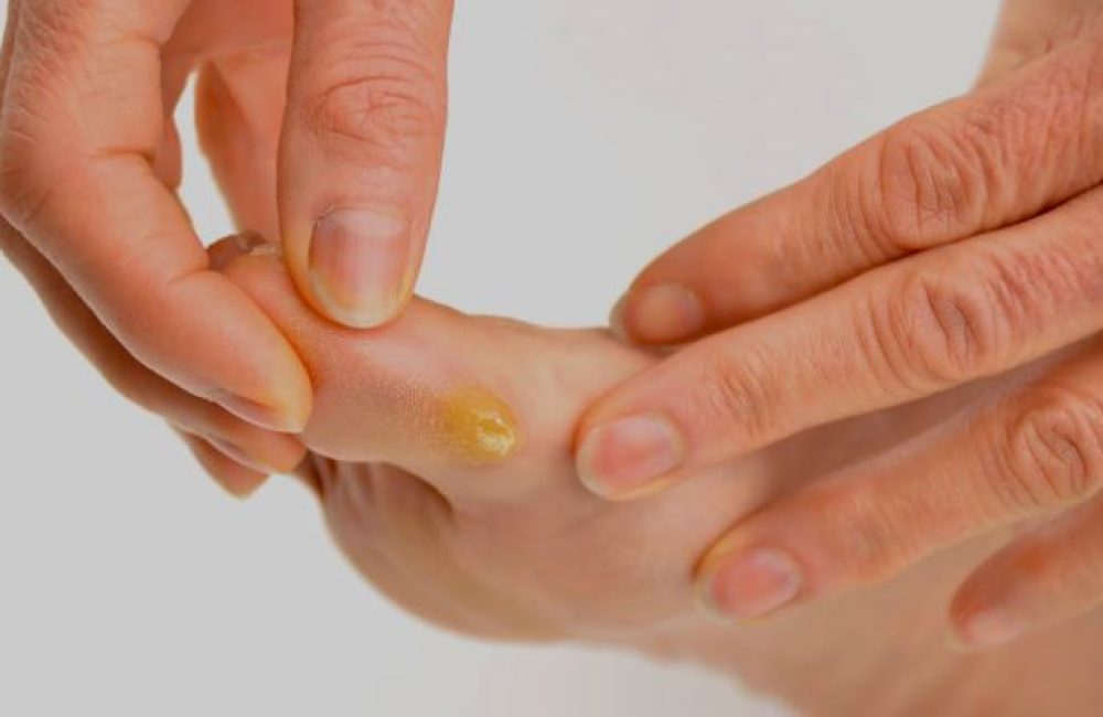 Callus Removal