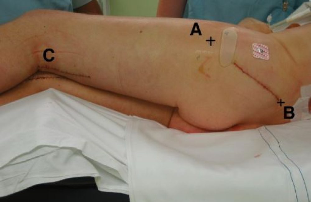 Femoro-Popliteal Bypass