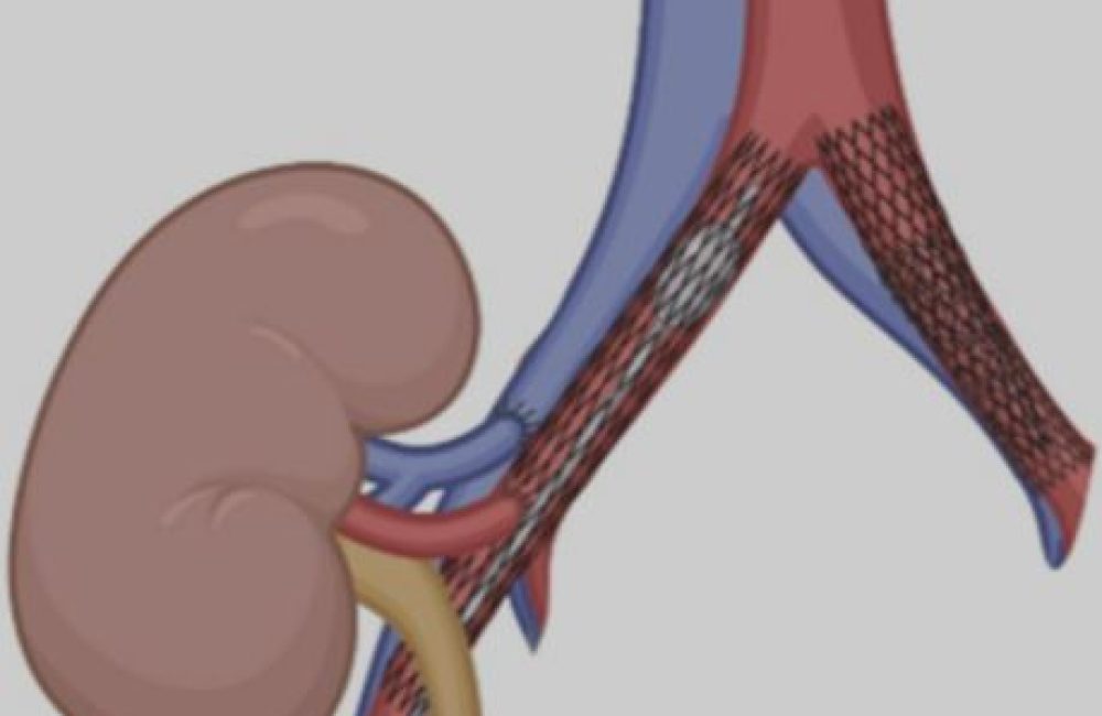 Iliac Angioplasty (CIA/EIA)