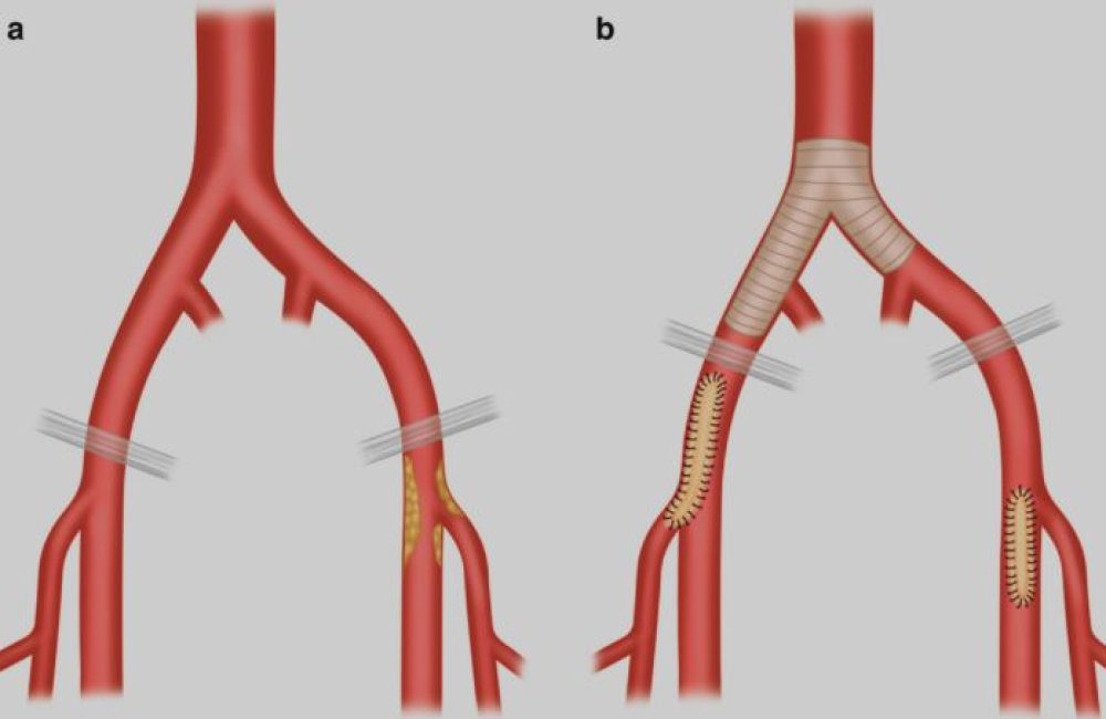 Aorto-Iliac Kissing Stent Angioplasty