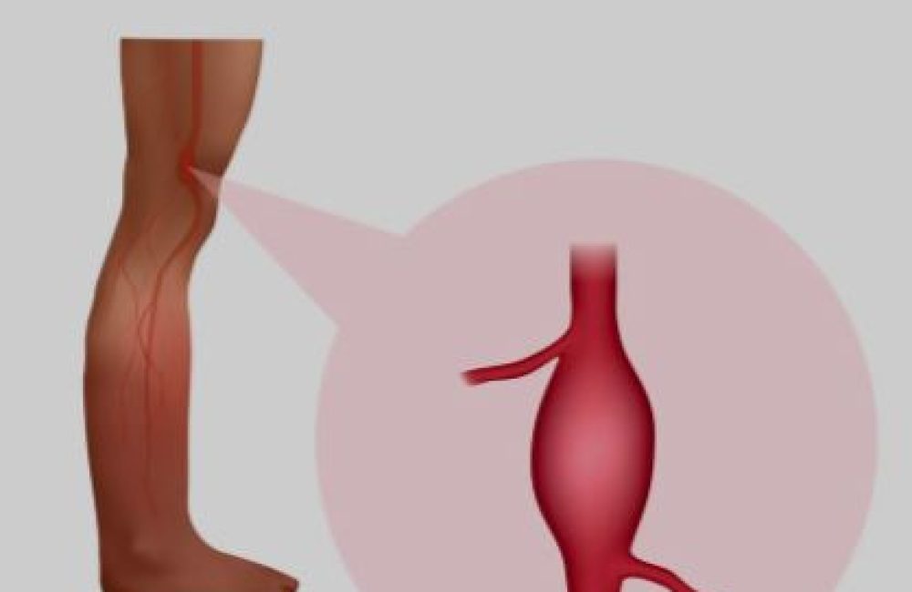Popliteal Artery Aneurysm