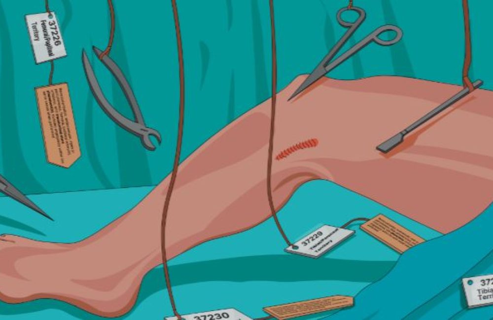 Popliteal Angioplasty / Stenting