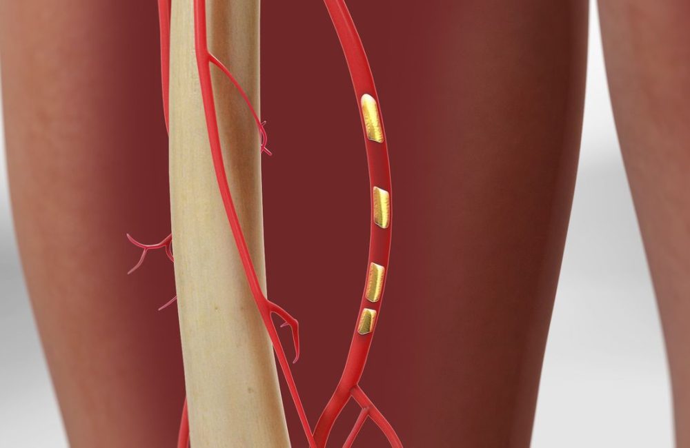 Peripheral Arterial Angioplasty