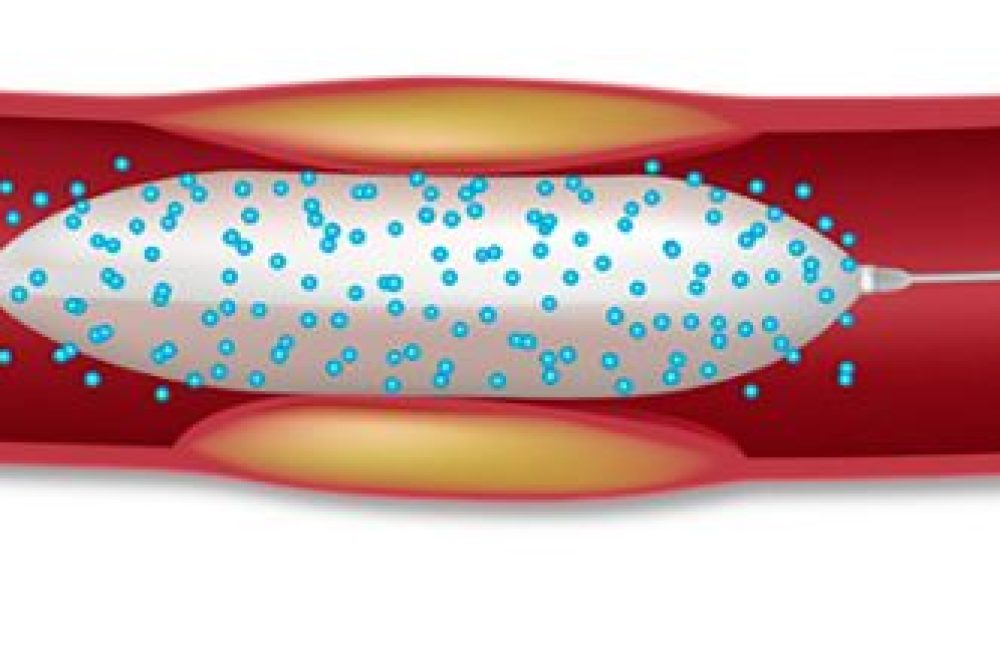 SFA Balloon Angioplasty / Stenting