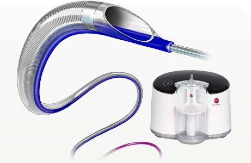 Thromboaspiration (Penumbra, Angioget)