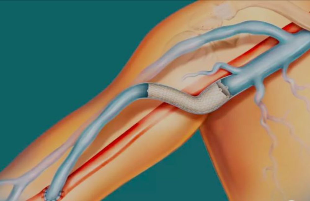 Innominate Vein Stenting